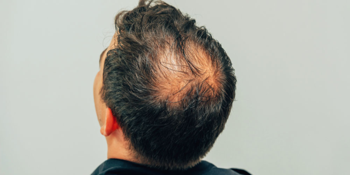 Hair Fall Treatment