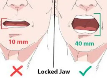 Lockjaw Jaw Locking